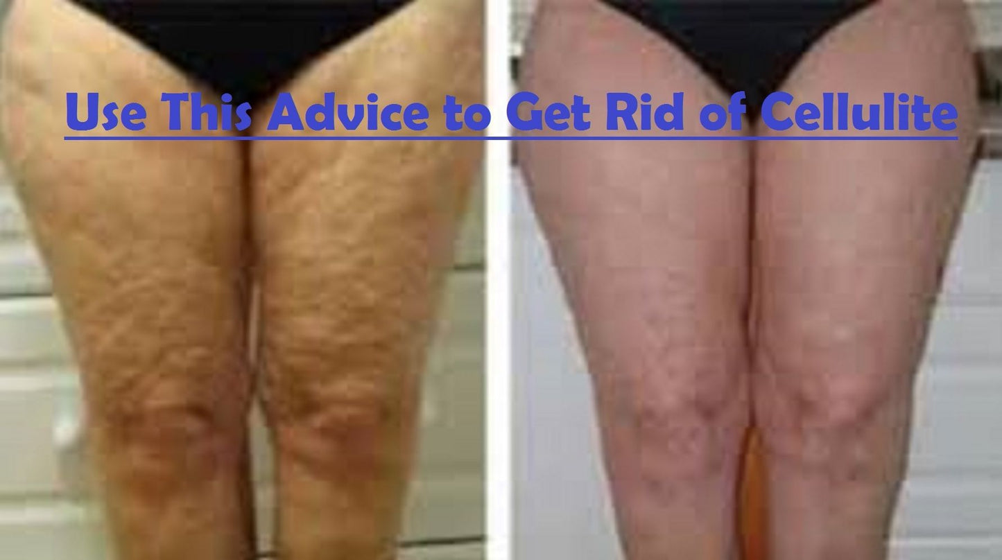 Use This Advice To Get Rid Of Cellulite