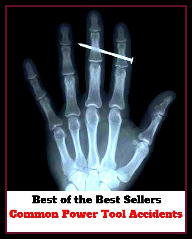 Best of the Best Sellers Common Power Tool Accidents (common pleas, common plum, common chard, common polyp, common pond-skater, common privet, common purpose, common purse, common pursuant, common quail)