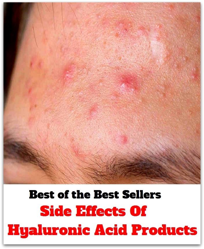 Best of the best sellers Side Effects Of Hyaluronic Acid Products ( exercise, meditation, acupuncture, disease, digestive system, formula, medicine, remedy, fix, treatment, action, conduct, behavior, handling, gastrin, fitness, vitamins, healing, diet )