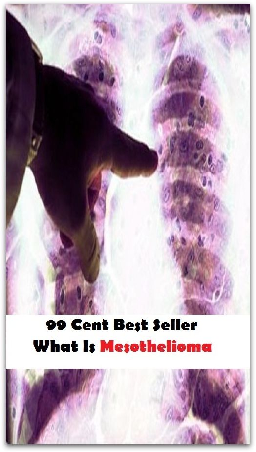 99 Cent Best Seller What Is Mesothelioma (Affiliate marketing,Online marketing, Art, Theology, Ethics, Chicken Soup, Thought, Theory, Self Help, Mystery, romance, action, adventure, sci fi, science fiction, drama, horror, thriller, classic )