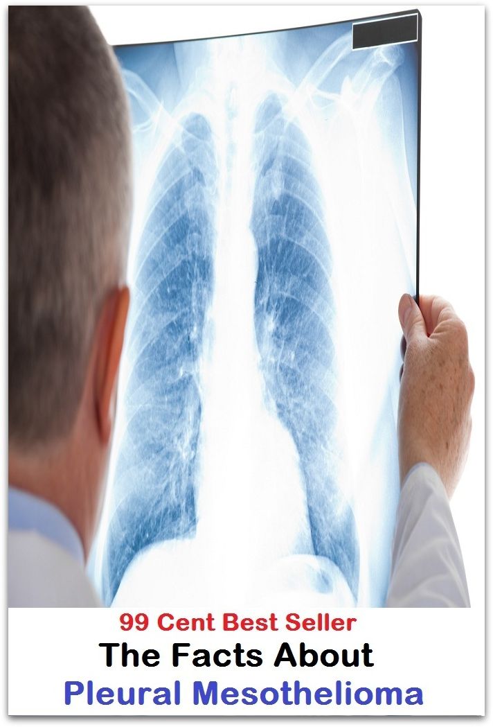 99 Cent Best Seller The Facts About Pleural Mesothelioma