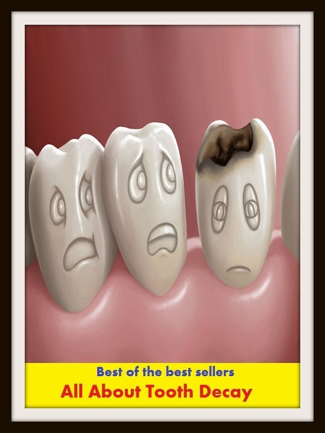Best of the Best Sellers All About Tooth Decay ( tusk, cuspid, indent, sapour, sapor, palate, zest, relish, penchant, luster, liking )