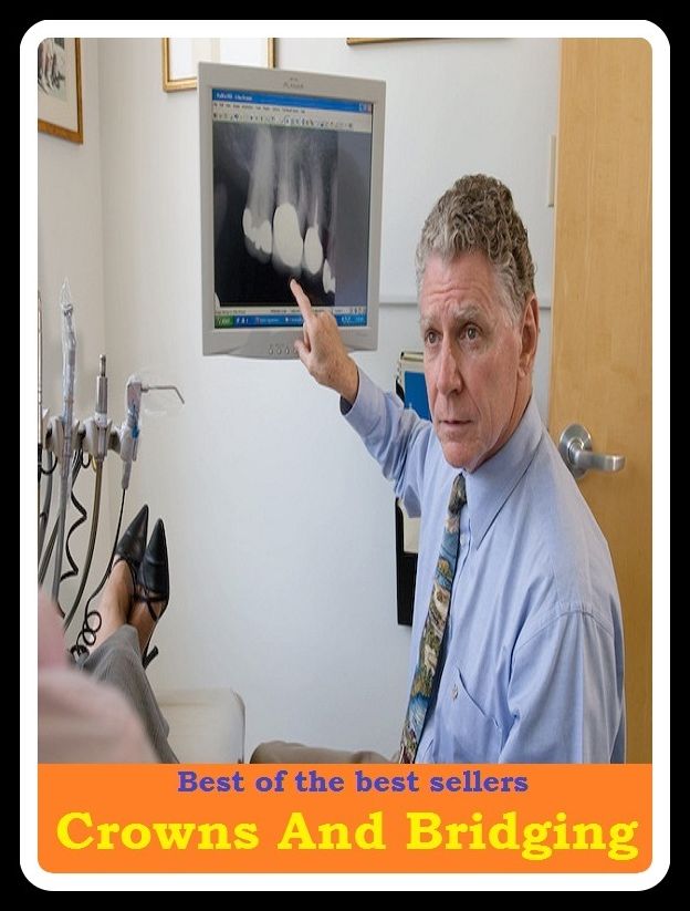 Best of the Best Sellers Crowns And Bridging ( coronet, palate, crown, flat of the hand, king, monarch, raja, rajah, prince, master )