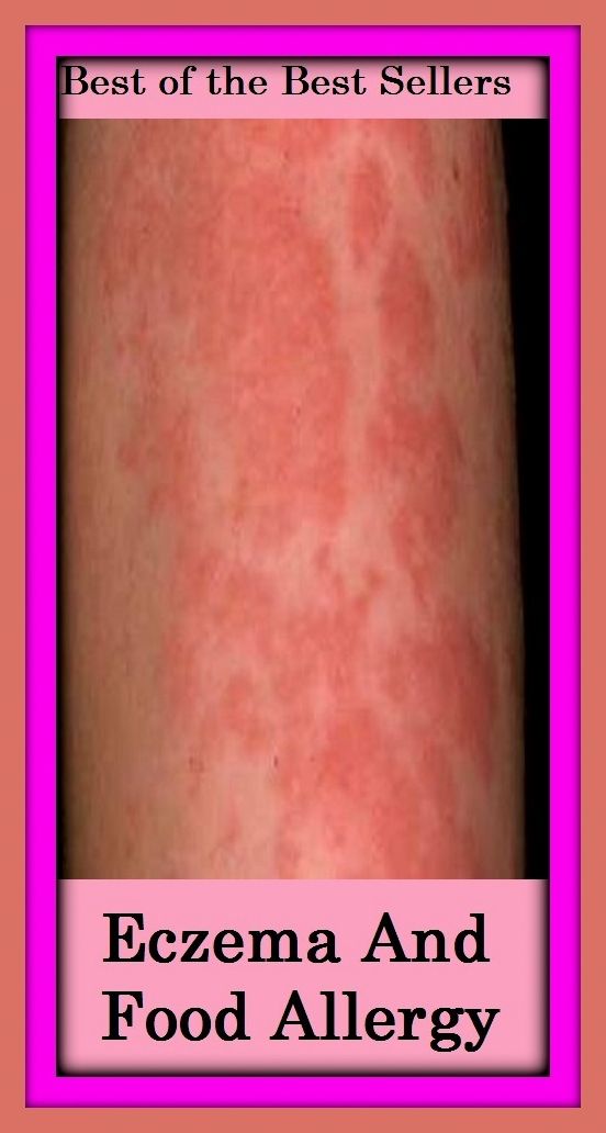 Best of the Best Sellers Eczema And Food Allergy ( abhorrence, animosity, animus, antagonism, aversion, avoidance, bad blood, contrariety, distaste, ill will )