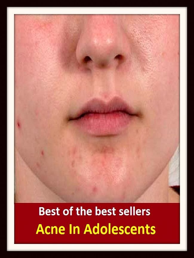 Best of the Best Sellers Acne In Adolescents (juvenile, teenager, youth, teen, minor, youngster, stripling, sweet sixteen)