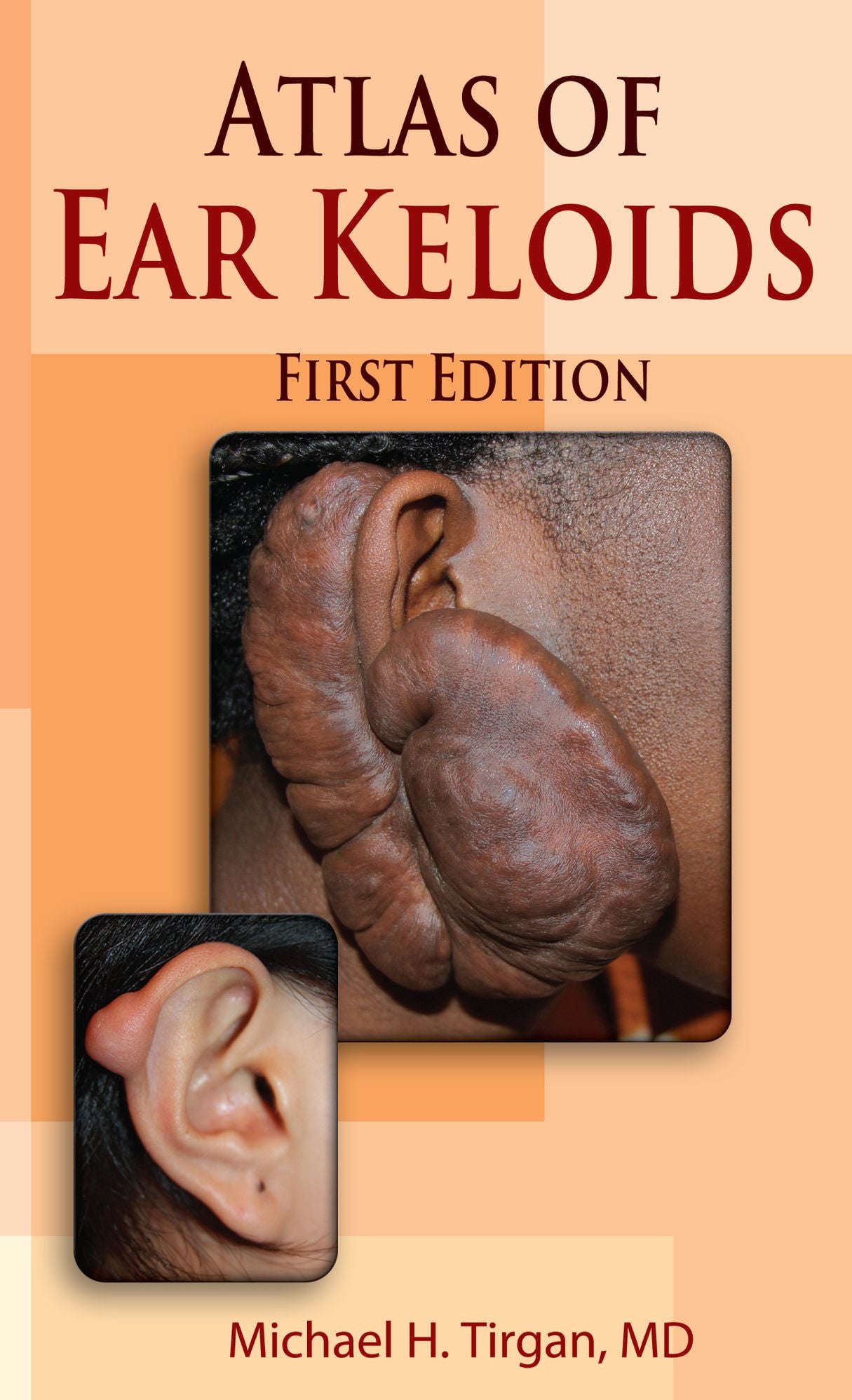 Atlas of Ear Keloids