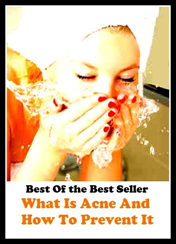 Best of the best seller What Is Acne And How To Prevent It (blackheads, pimples, pustules, rosacea, zits, whiteheads, skin inflammation, pizza face, tumor, eruption)