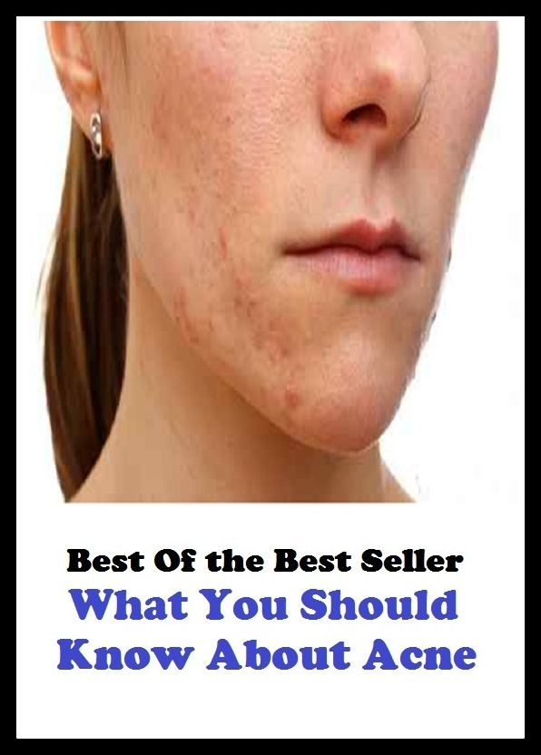 Best of the best seller What You Should Know About Acne (blackheads,pimples,pustules ,rosacea, zits, whiteheads, skin inflammation, pizza face, tumor, eruption)