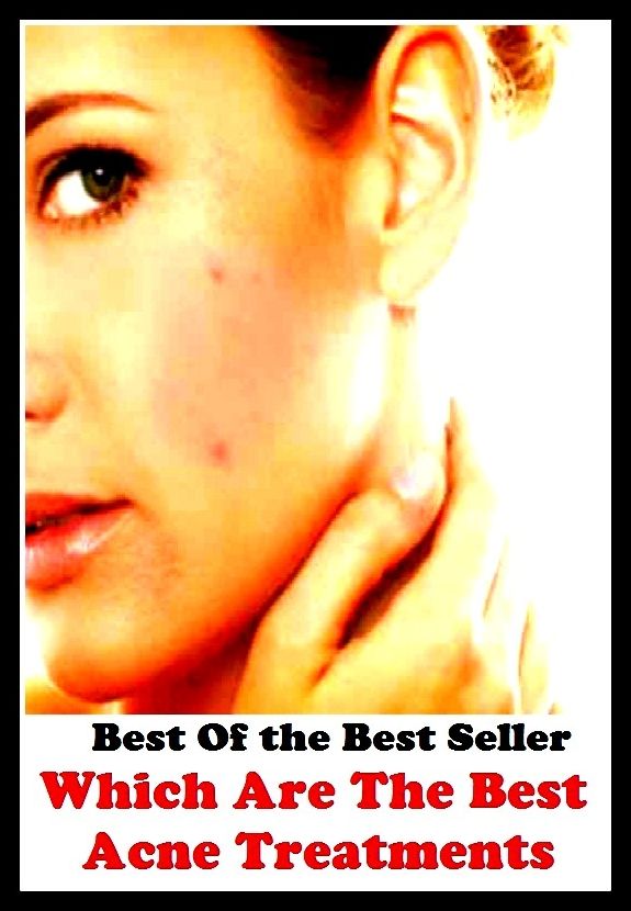 Best of the Best Sellers Which Are The Best Acne Treatments It D (behavior, dealing, analysis, hospitalization, regiment, surgery,therapy, medication, prescription, operation)