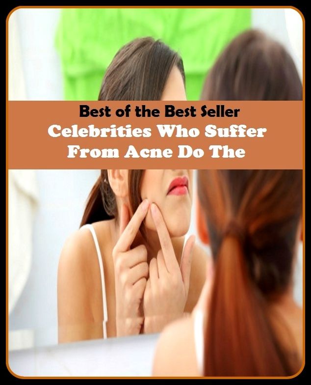 Best of the Best Sellers Celebrities Who Suffer From Acne Do The(blackheads,pimples,pustules,rosacea,zits, whiteheads, skin inflammation, pizza face, tumor, eruption)