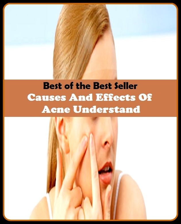 Best of the Best Sellers Causes And Effects Of Acne Understand(blackheads,pimples,pustules,rosacea,zits, whiteheads, skin inflammation, pizza face, tumor, eruption)
