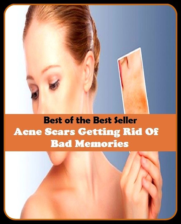Best of the Best Sellers Acne Scars Getting Rid Of Bad Memories (blackheads,pimples,pustules,rosacea,zits, whiteheads, skin inflammation, pizza face, tumor, eruption)