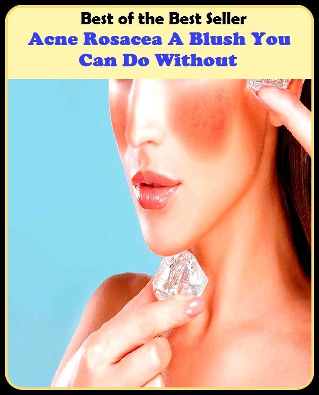 Best of the Best Sellers Acne Rosacea A Blush You Can Do Without (blackheads,pimples,pustules,rosacea,zits, whiteheads, skin inflammation, pizza face, tumor, eruption)