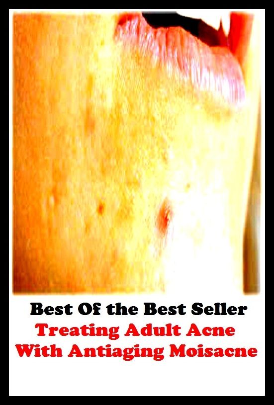 Best of the Best Sellers Treating Adult Acne With Antiaging Moisacne : (blackheads,pimples,pustules,rosacea,zits, whiteheads, skin inflammation, pizza face, tumor, eruption)