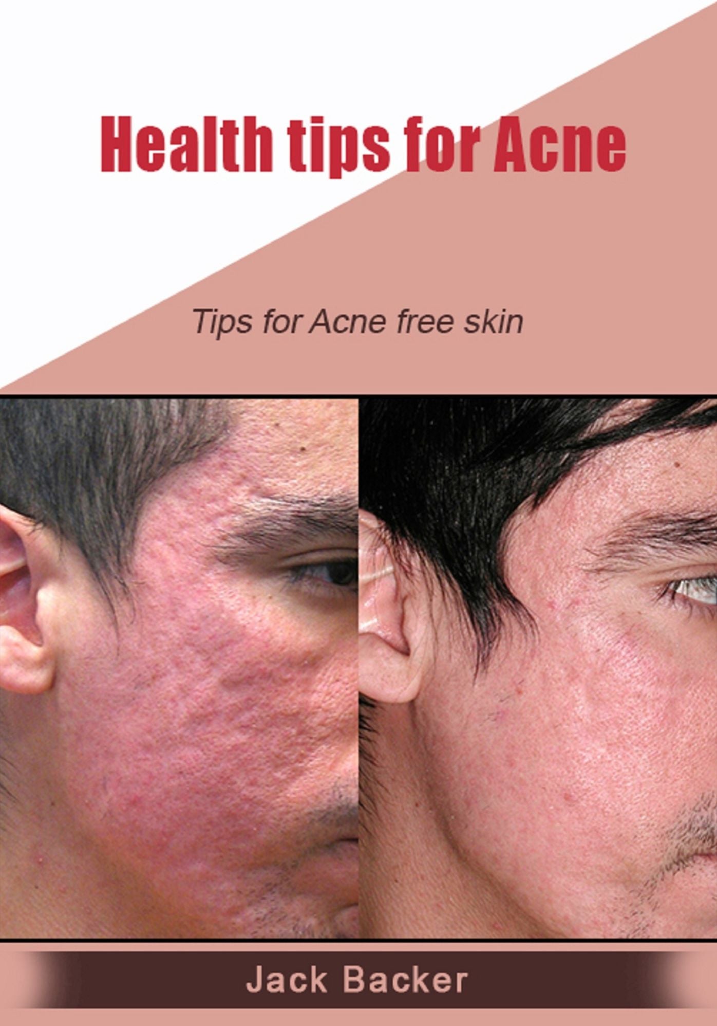 Health tips for Acne