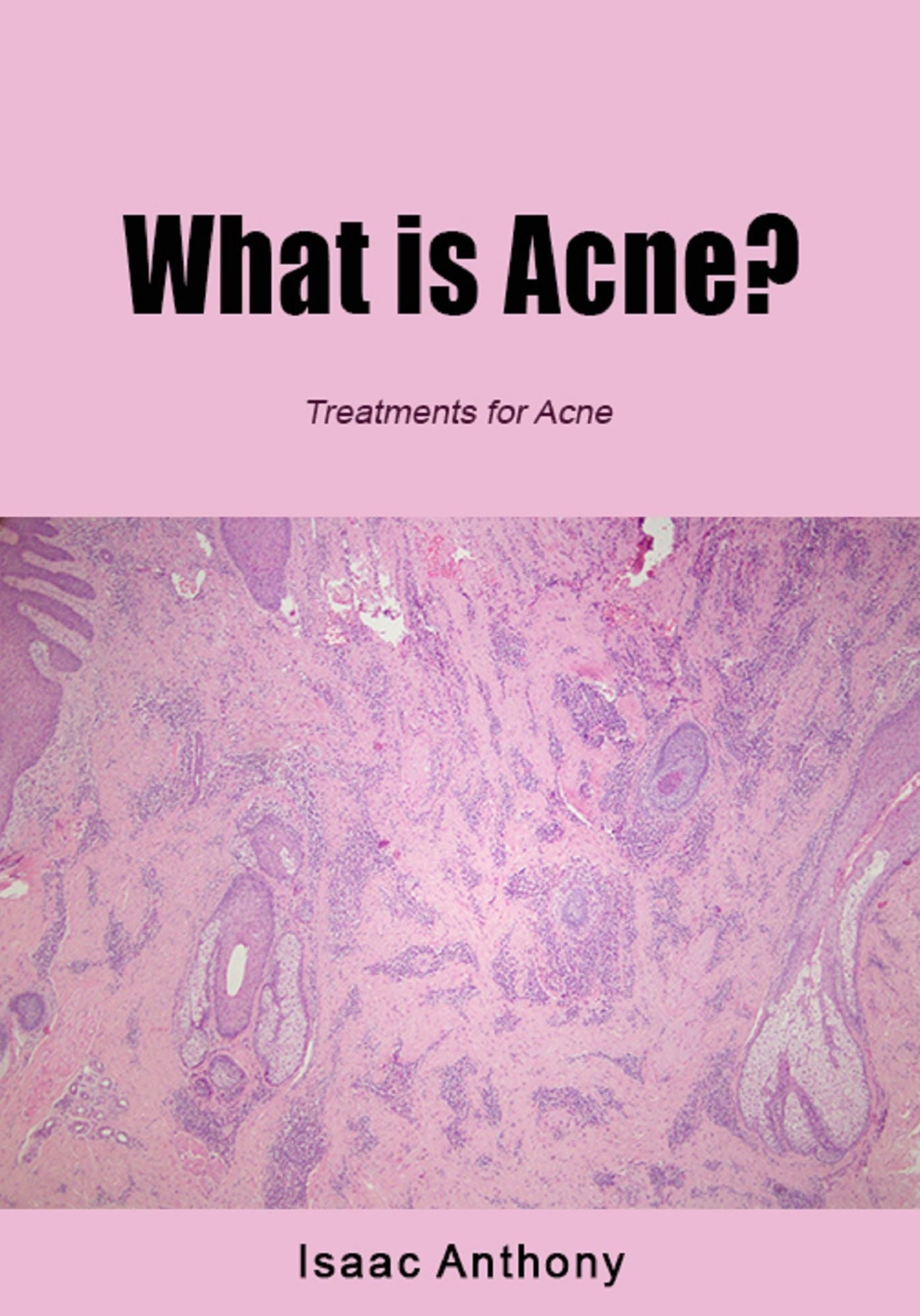 What is Acne