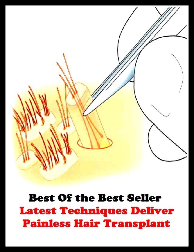 Best of the best seller Latest Techniques Deliver Painless Hair Transpl(energy,fitness,strength,well-being,bloom,complexion,constitution,euphoria,fettle,form)