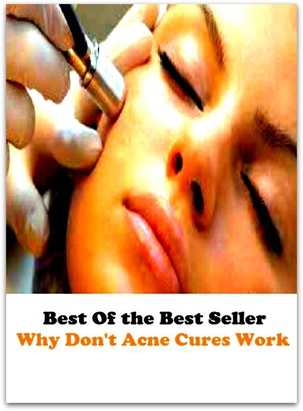 Best of the Best Sellers Why Dont Acne Cures Work (medication, healing, prescript, salve, remedy, recovery, fix , aid, antidote, panacea)