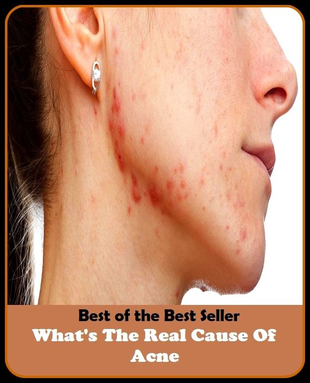 Best of the Best Sellers What S The Real Cause Of Acne (blackheads,pimples,pustules,rosacea,zits, whiteheads, skin inflammation, pizza face, tumor,eruption)