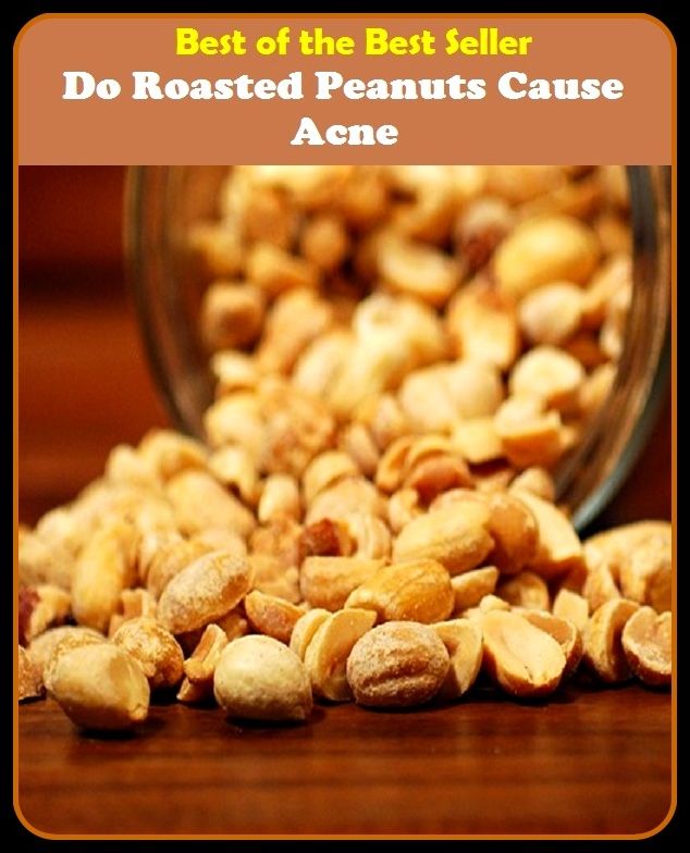 Best of the Best Sellers Do Roasted Peanuts Cause Acne (blackheads,pimples,pustules,rosacea,zits, whiteheads, skin inflammation, pizza face, tumor, eruption)