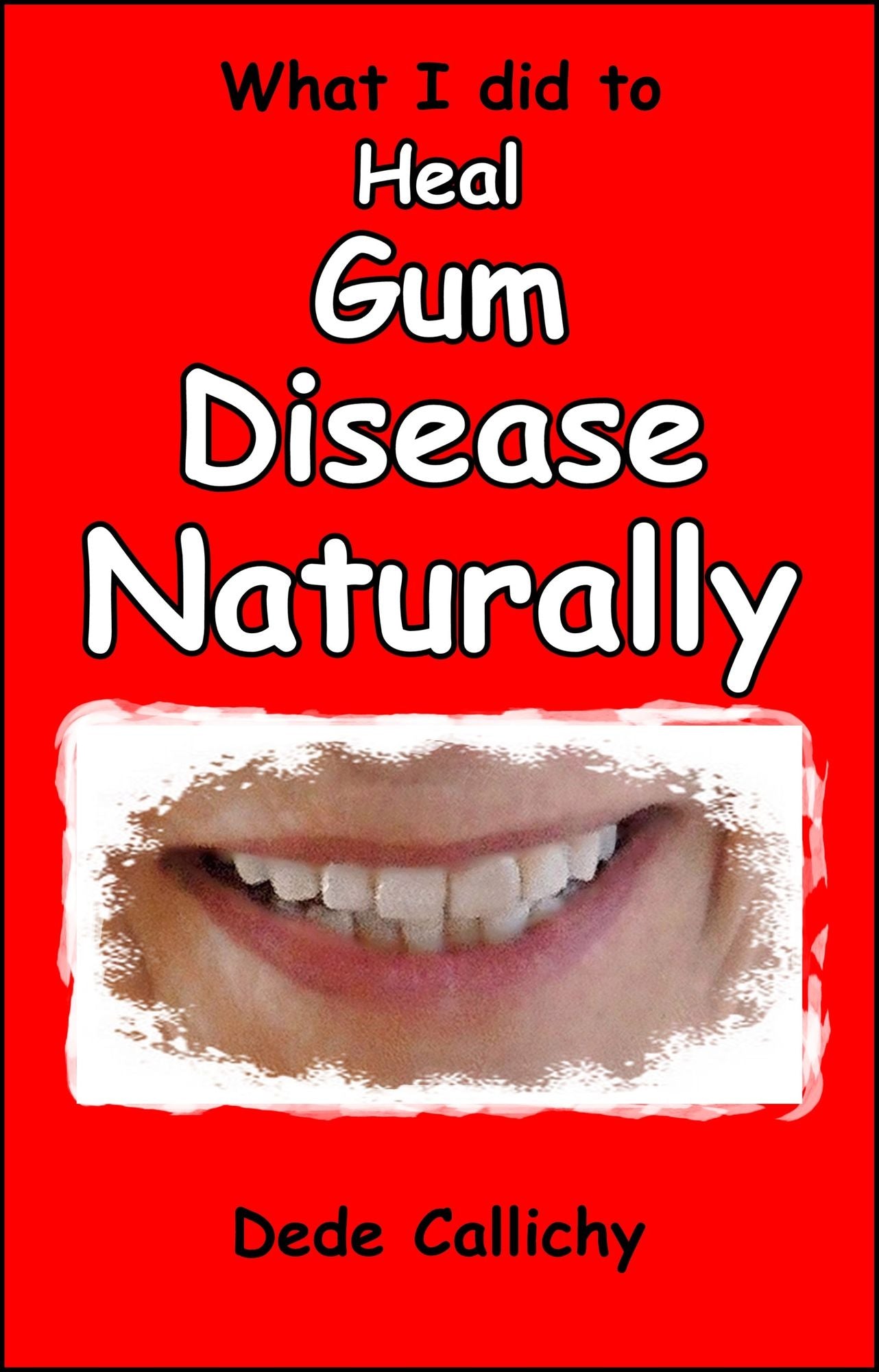 What I did to Heal Gum Disease Naturally