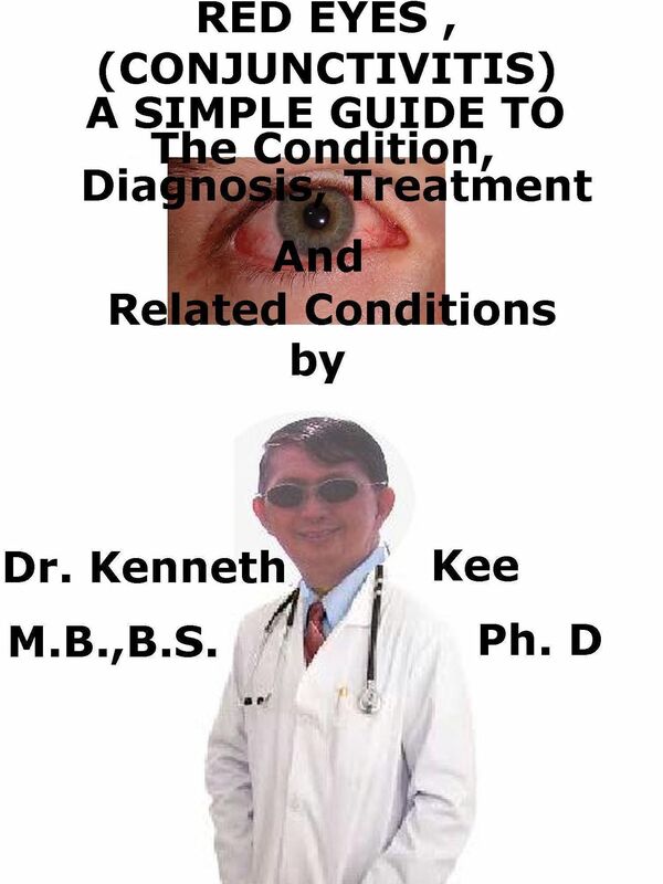 Red Eyes (Conjunctivitis), A Simple Guide To The Condition, Diagnosis, Treatment And Related Conditions