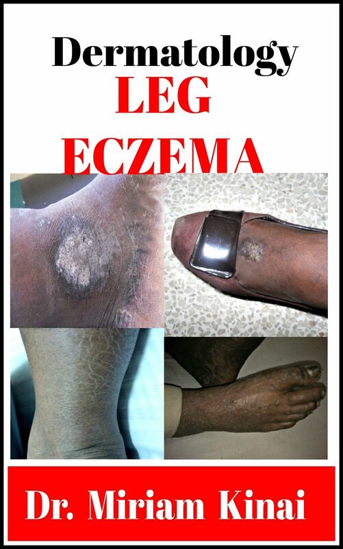 Dermatology: Leg Eczema