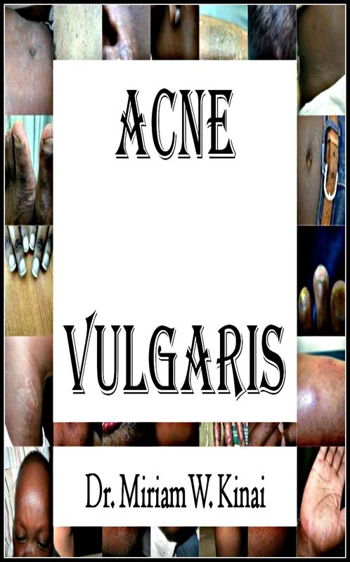 Acne Vulgaris