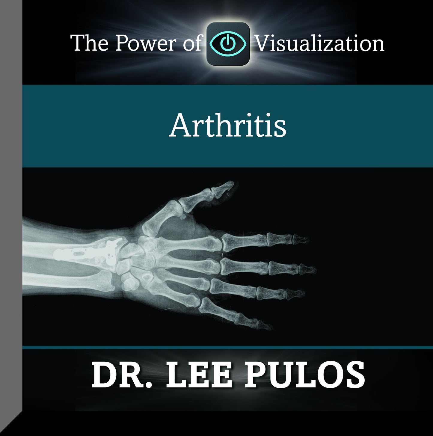 Arthritis