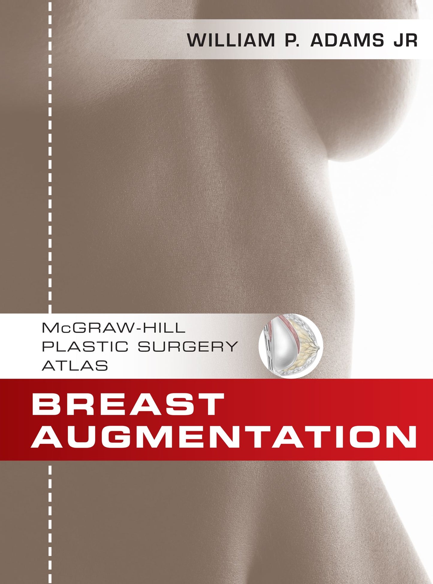 Breast Augmentation: An Operative Atlas EBOOK
