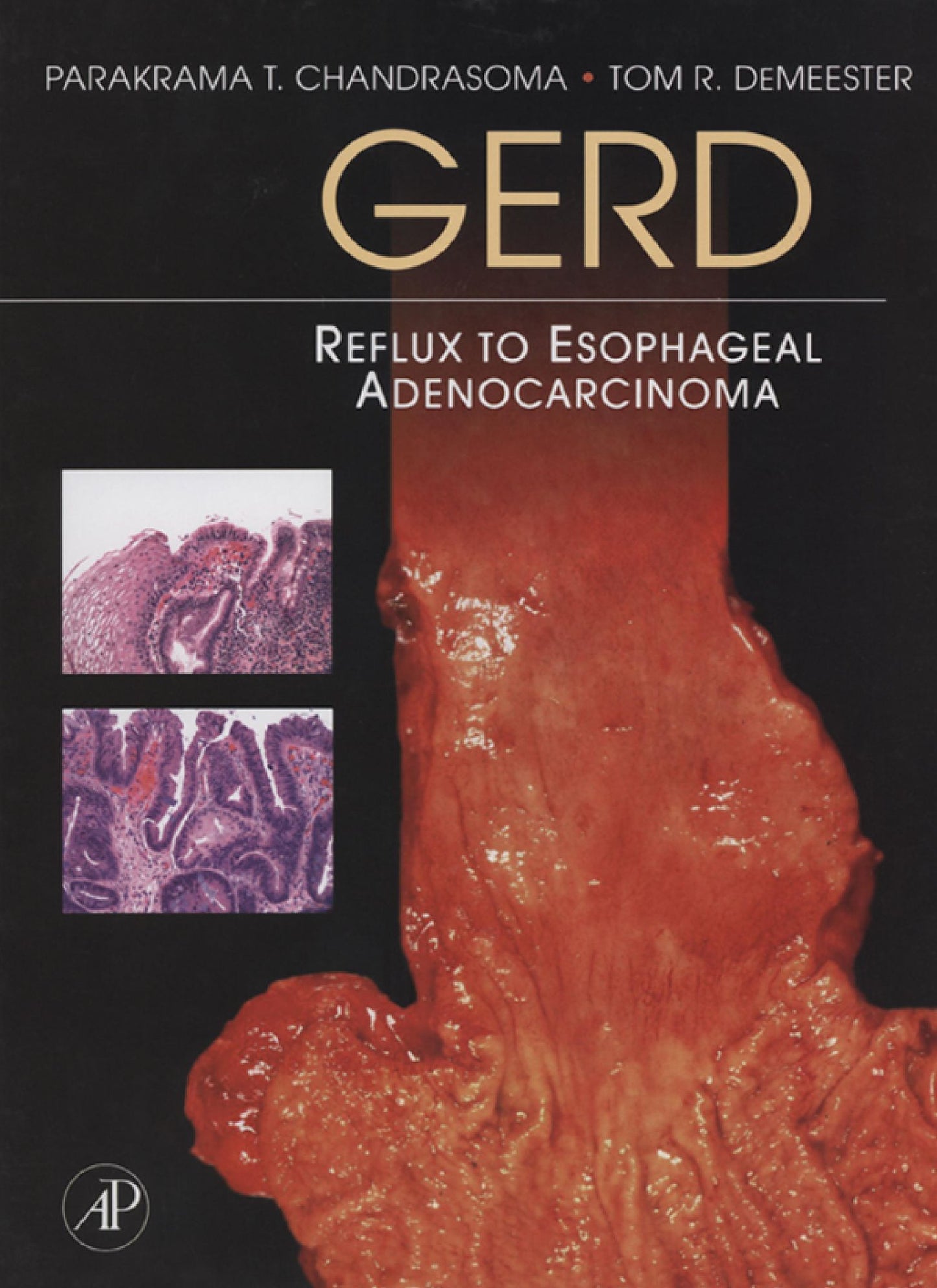 GERD: Reflux to Esophageal Adenocarcinoma