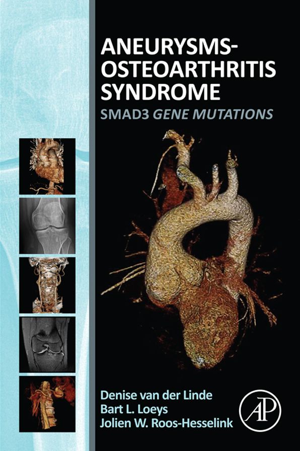 Aneurysms-Osteoarthritis Syndrome: SMAD3 Gene Mutations