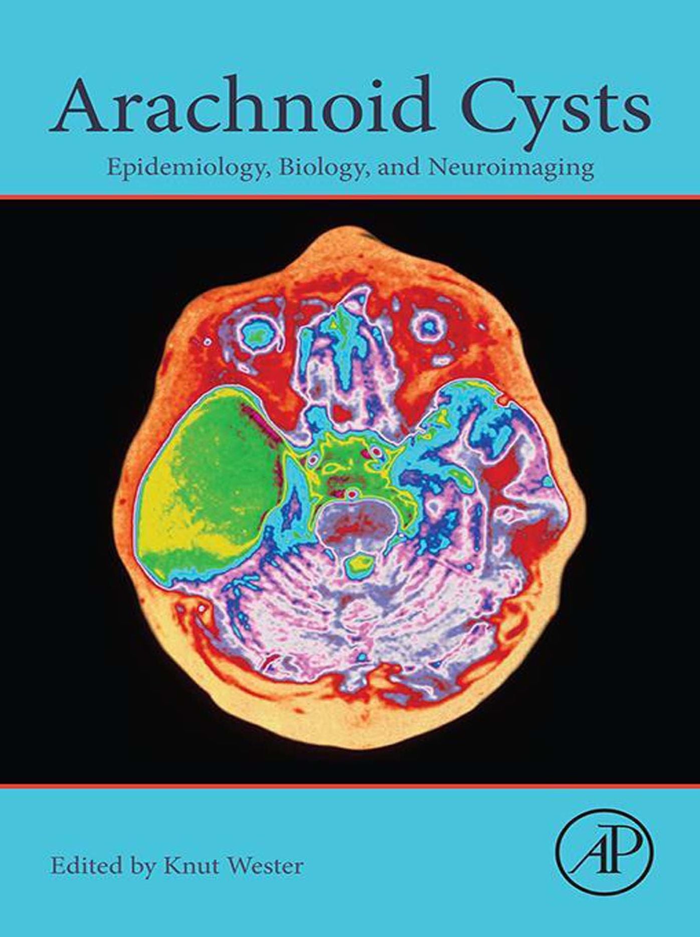 Arachnoid Cysts: Epidemiology, Biology, and Neuroimaging