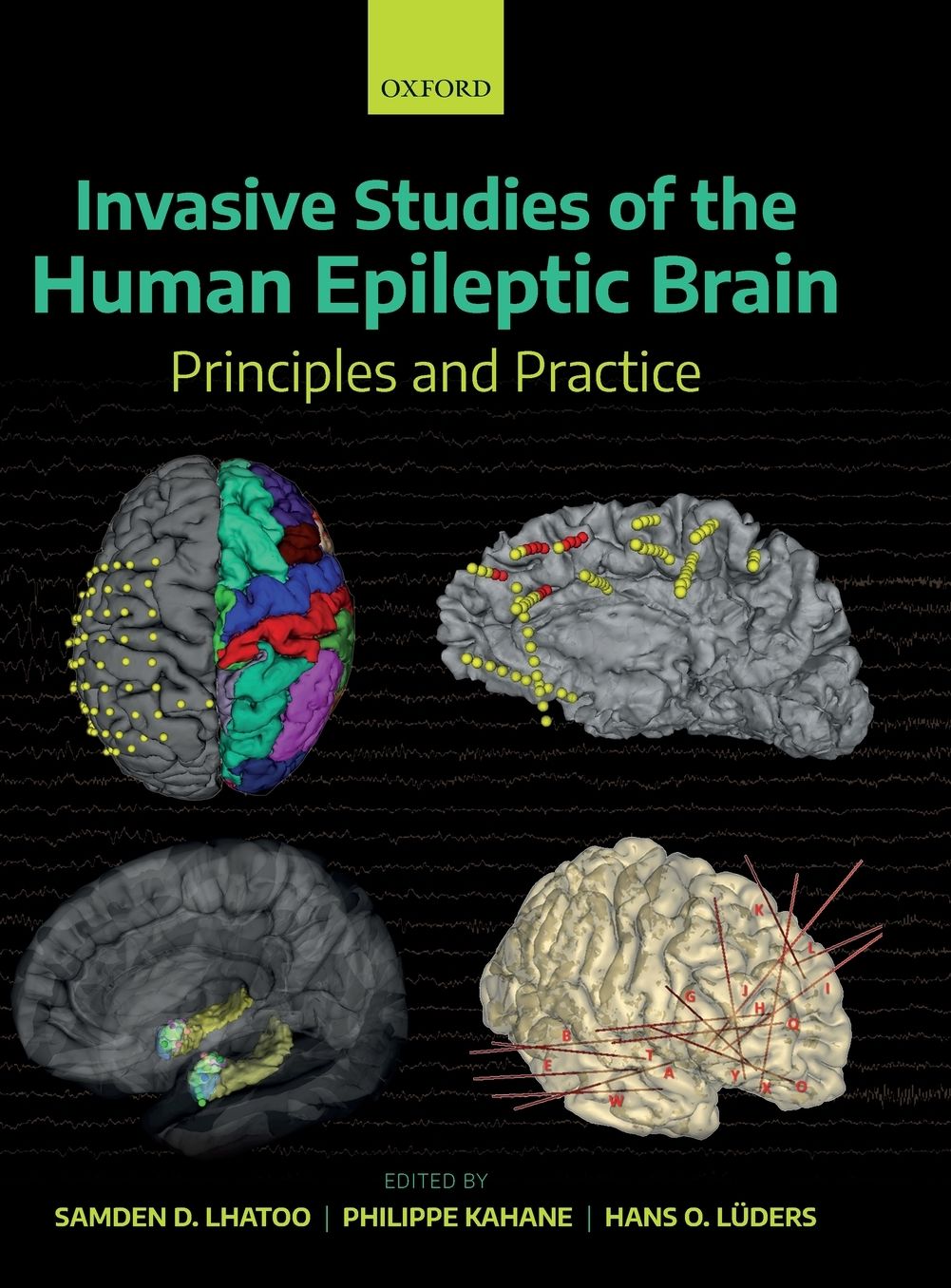 Invasive Studies of the Human Epileptic Brain: Principles and Practice