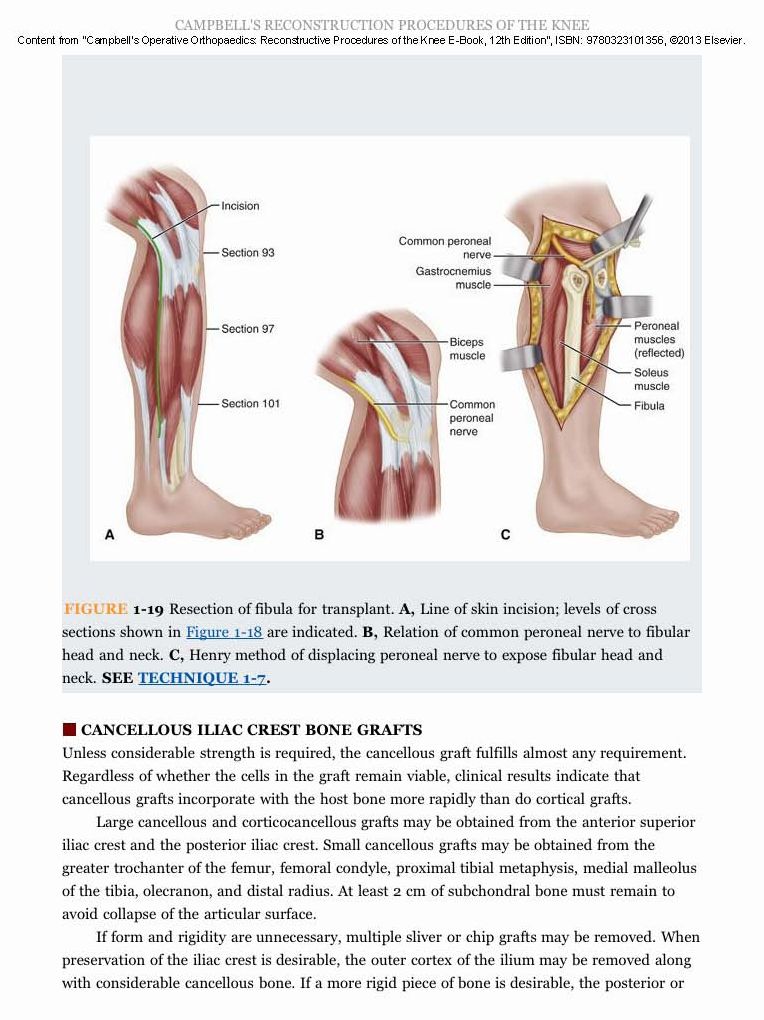 Campbell's Operative Orthopaedics: Reconstructive Procedures of the Knee E-Book