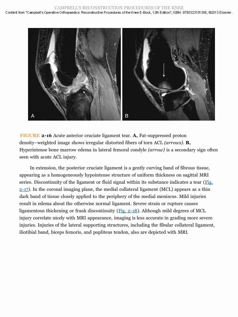Campbell's Operative Orthopaedics: Reconstructive Procedures of the Knee E-Book