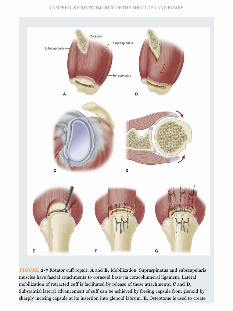 Campbell's Operative Orthopaedics: Sports Injuries of the Shoulder and Elbow E-Book