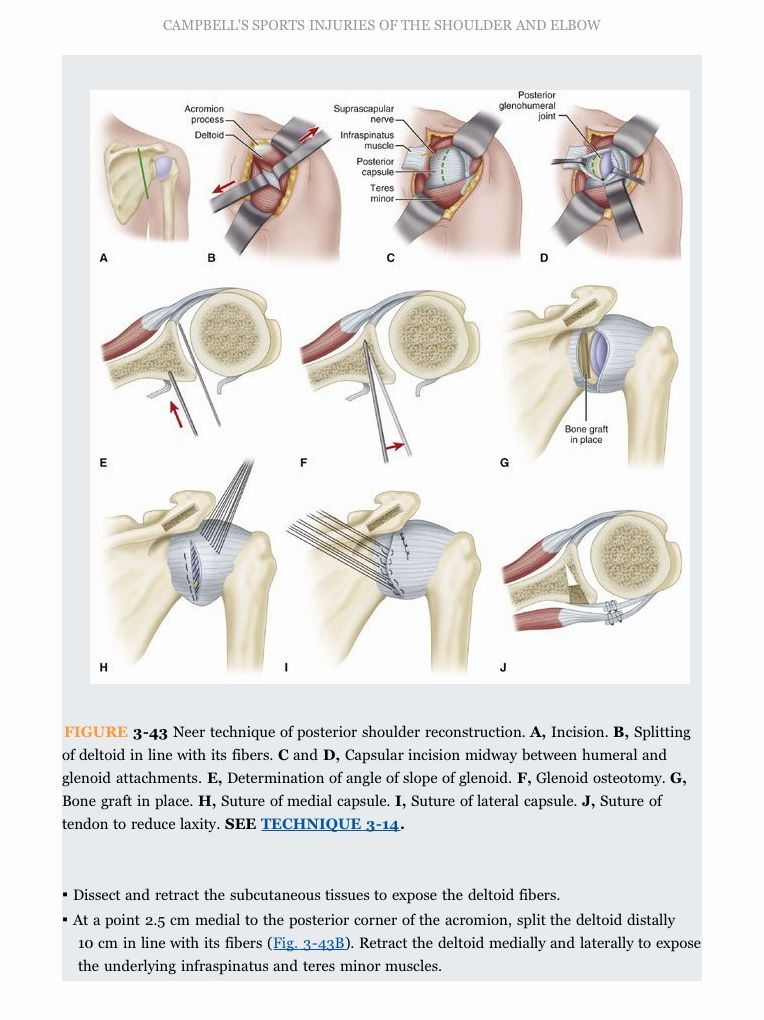 Campbell's Operative Orthopaedics: Sports Injuries of the Shoulder and Elbow E-Book