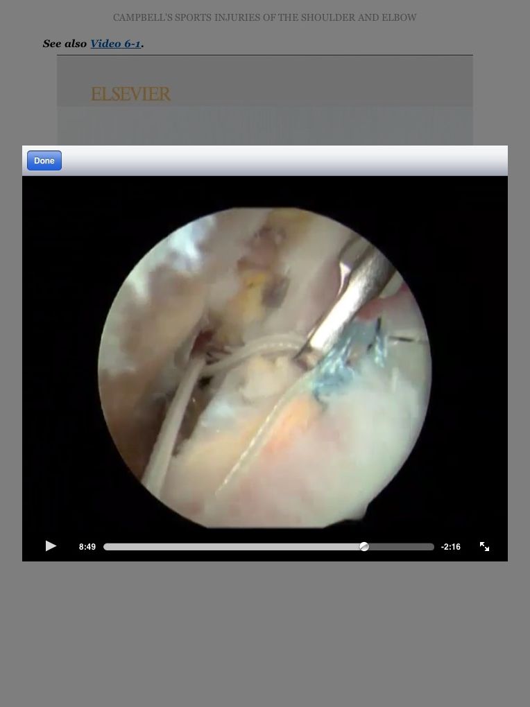 Campbell's Operative Orthopaedics: Sports Injuries of the Shoulder and Elbow E-Book