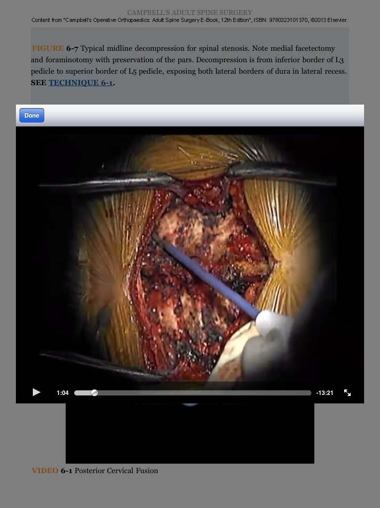 Campbell's Operative Orthopaedics: Adult Spine Surgery E-Book