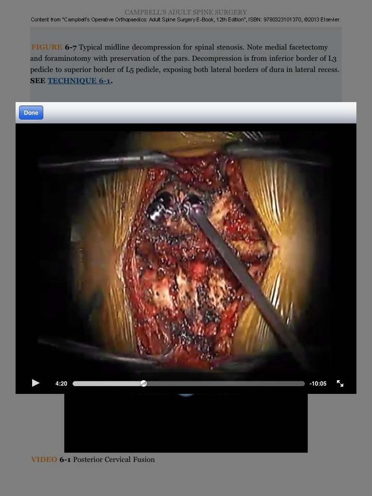 Campbell's Operative Orthopaedics: Adult Spine Surgery E-Book
