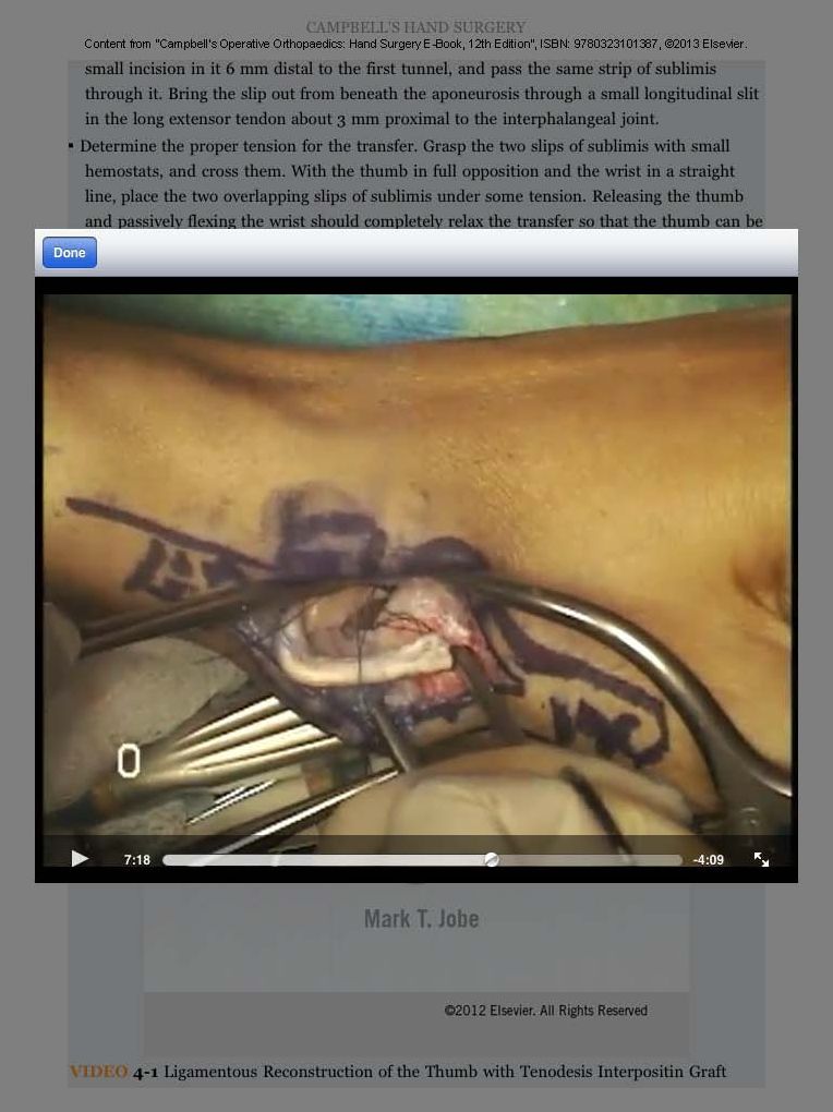 Campbell's Operative Orthopaedics: Hand Surgery E-Book