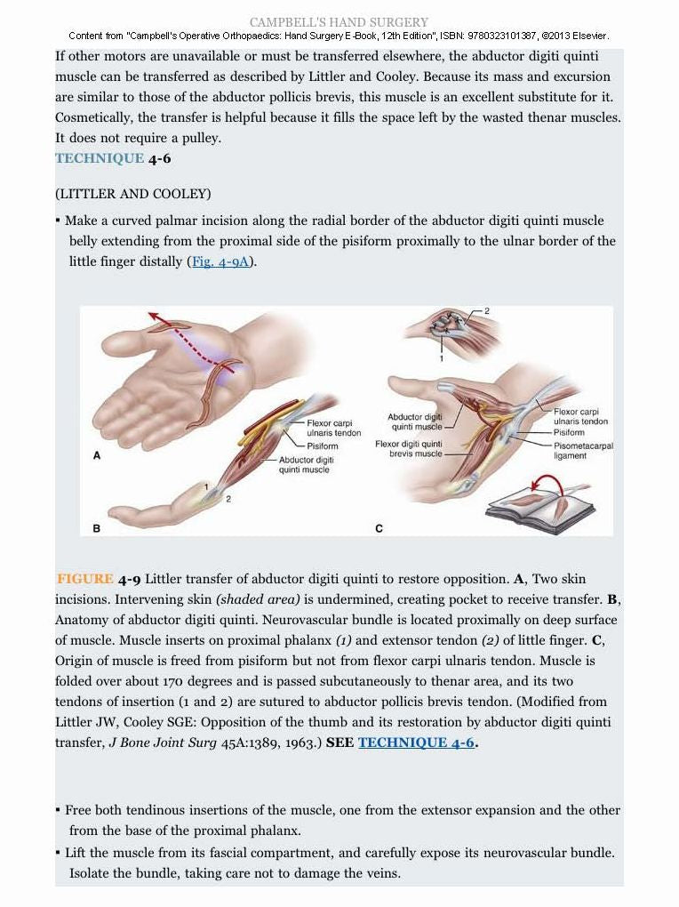 Campbell's Operative Orthopaedics: Hand Surgery E-Book