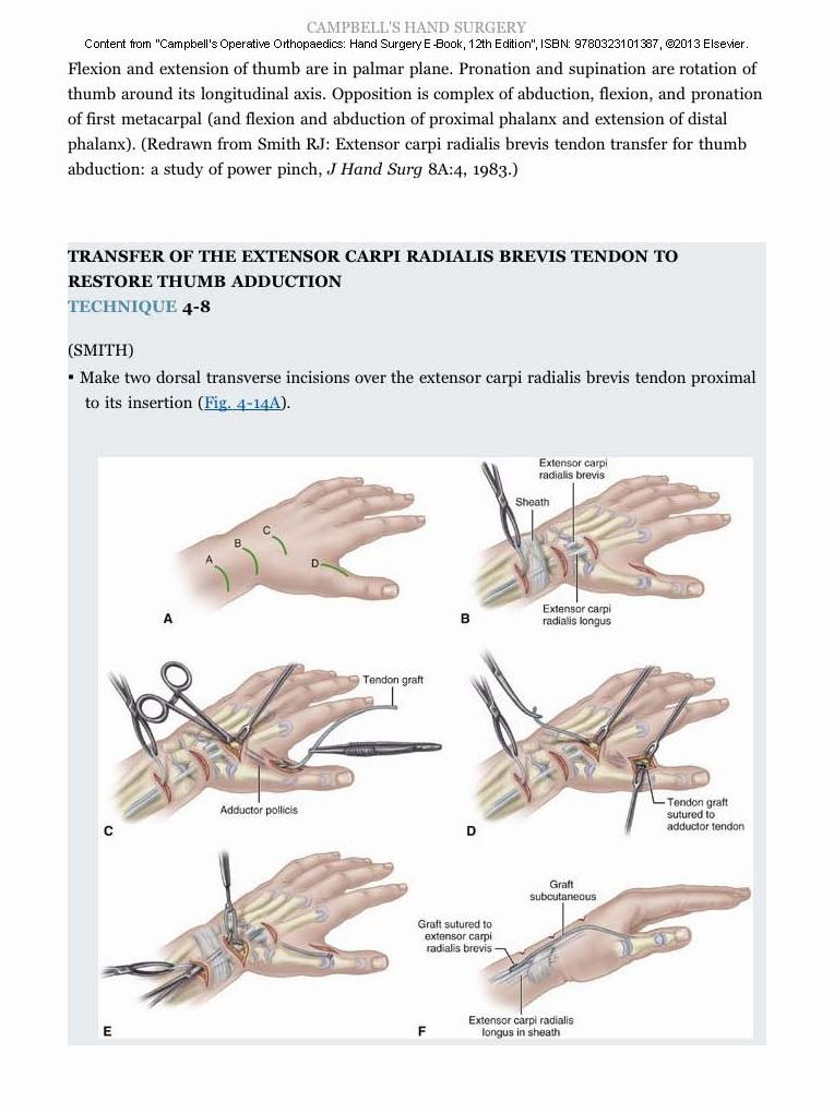 Campbell's Operative Orthopaedics: Hand Surgery E-Book