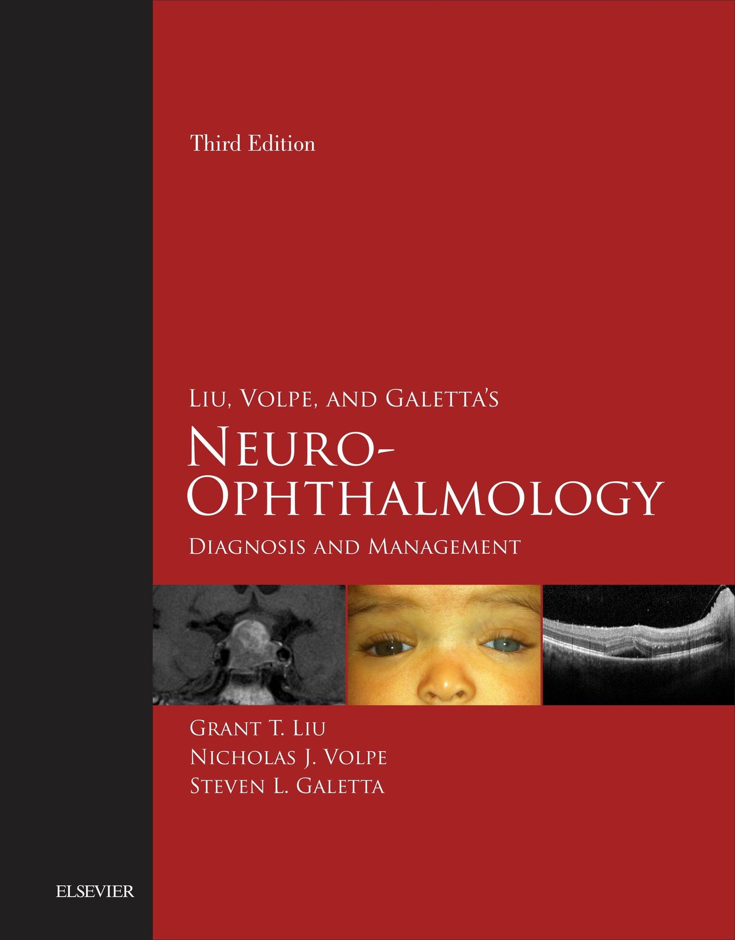 Liu, Volpe, and Galetta's Neuro-Ophthalmology E-Book: Diagnosis and Management