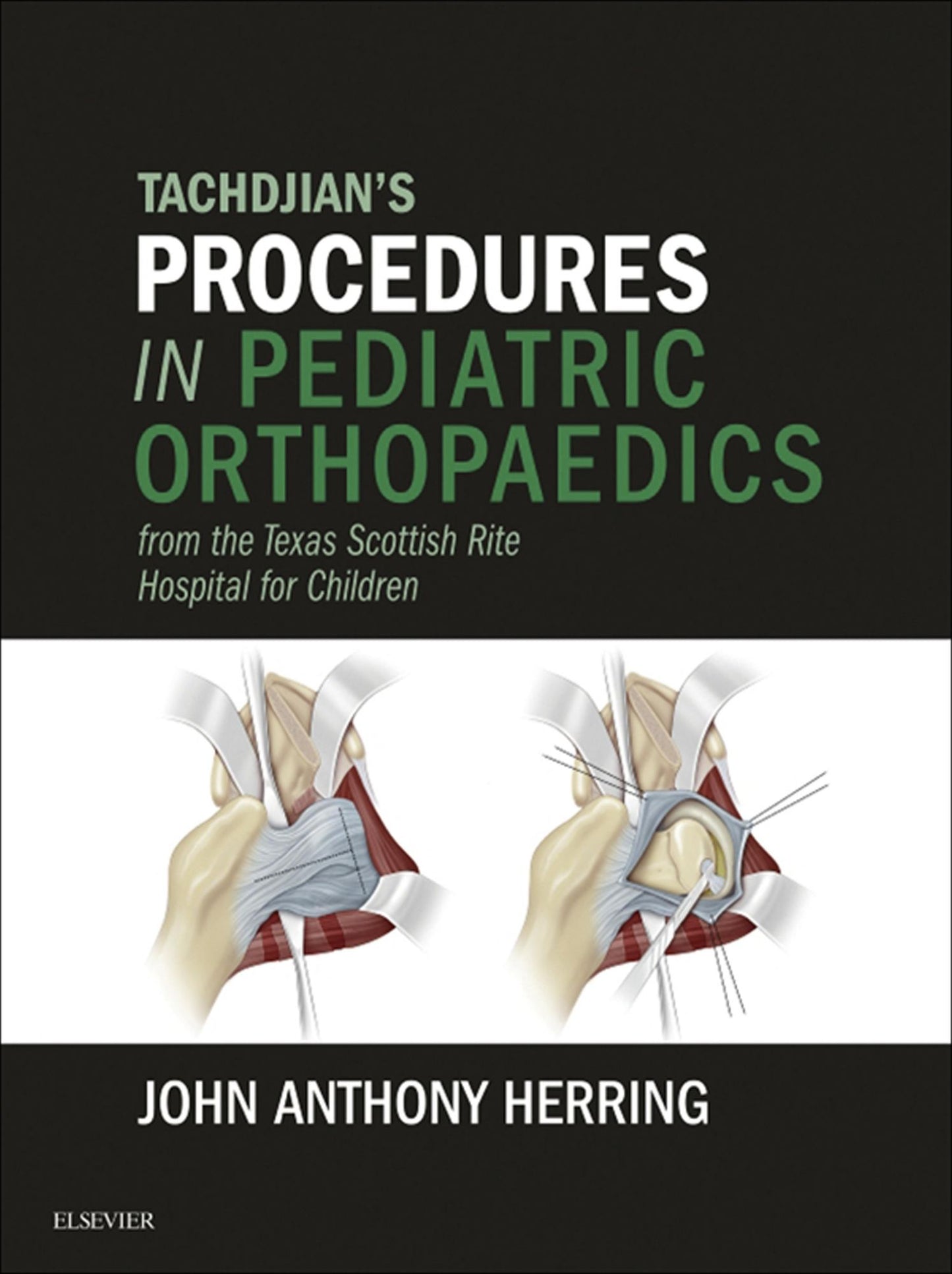 Tachdjian's Procedures in Pediatric Orthopaedics: From the Texas Scottish Rite Hospital for Children E-Book