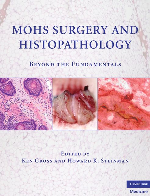 Mohs Surgery and Histopathology: Beyond the Fundamentals