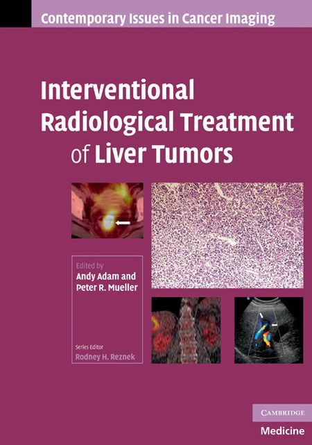 Interventional Radiological Treatment of Liver Tumors