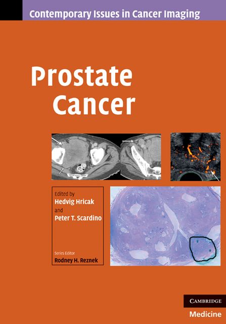 Prostate Cancer