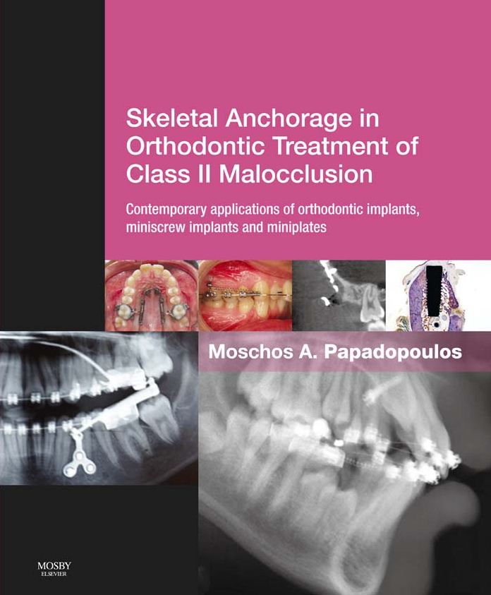 Skeletal Anchorage in Orthodontic Treatment of Class II Malocclusion E-Book: Contemporary applications of orthodontic implants, miniscrew implantsand mini plates